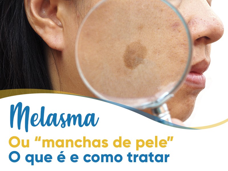 Melasma: o que é e como tratar